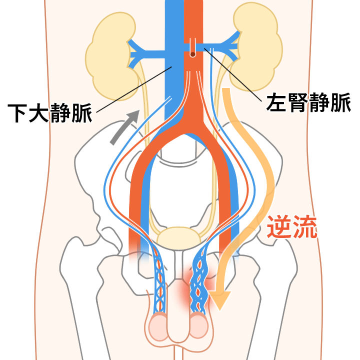 左腎静脈が腹大動脈と上腸間膜動脈に圧迫されるナットクラッカー現象が起こり、血液の戻りが悪くなります。