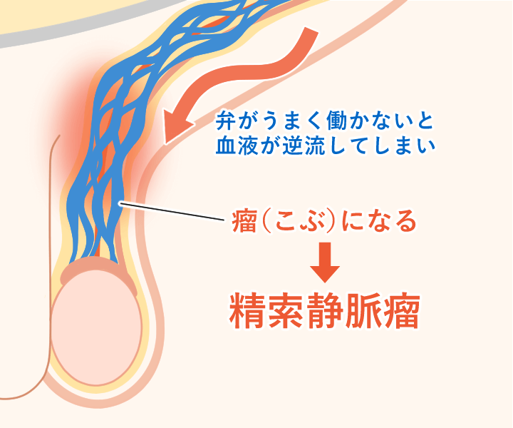 精索静脈瘤：弁がうまく働かないと、血液が逆流してしまい、瘤（こぶ）になる