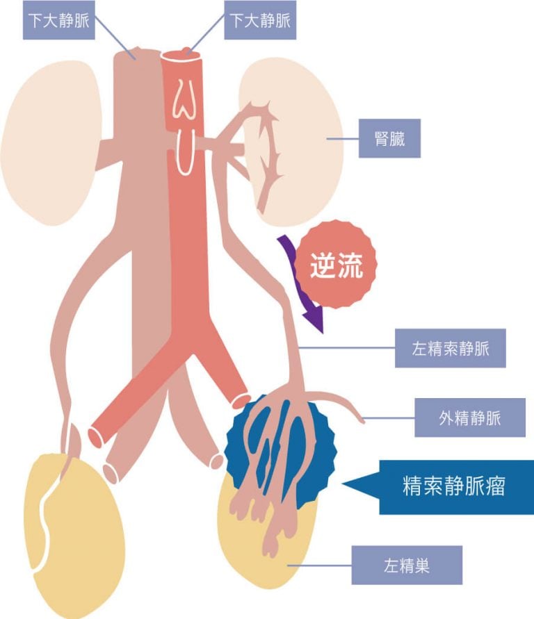 精索静脈瘤 | 【銀座リプロ外科】男性不妊手術専門クリニック