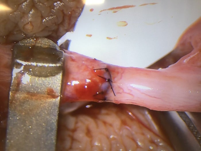 Image of actual connected vas deferens