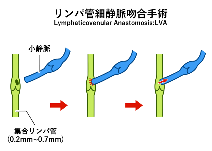 リンパ管吻合手術の方法