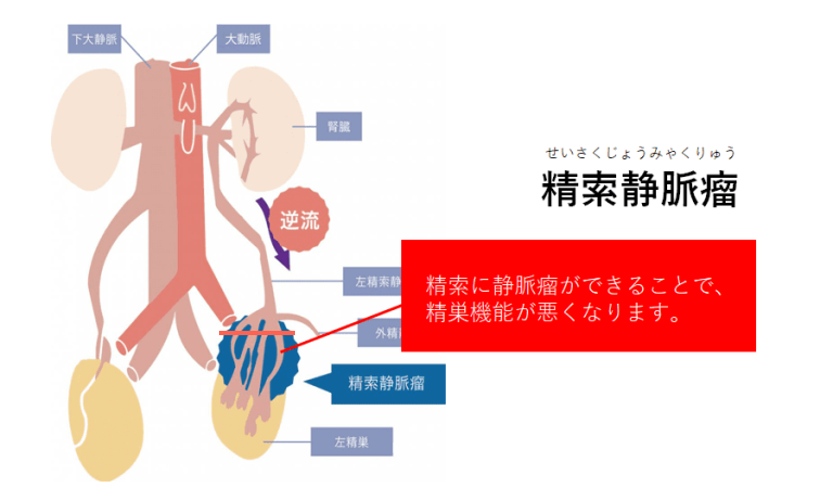 精索静脈瘤の原因1（弁の問題）