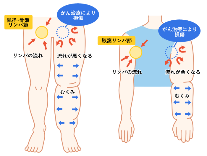 リンパ浮腫